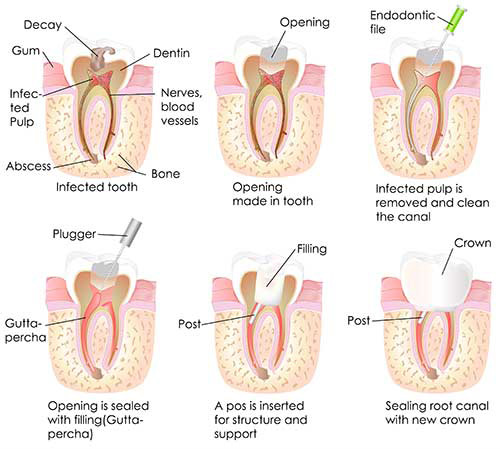 Rhodes Ranch Root Canals