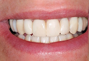 Spring Valley Before and After Invisalign