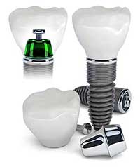 Dental Implants in Rhodes Ranch