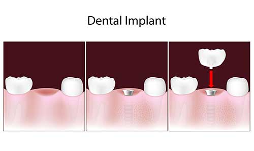 Implant Dentist in Rhodes Ranch