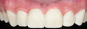Before and After Invisalign in Rhodes Ranch