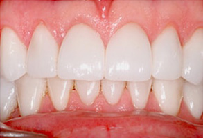 Spring Valley Before and After Dental Images