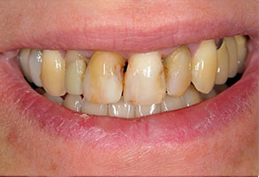 Rhodes Ranch Before and After Teeth Whitening