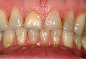 Spring Valley Before and After Teeth Whitening